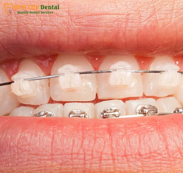 Average Cost of Teeth Braces [Revealed]: Save Money | Dr. Cuong