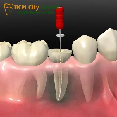 bad-breath-after-root-canal-treatment-3-dr-cuong-hcmc-dental-clinic-dr-cuong-hcmc-dental-clinic