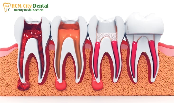 bad-breath-after-root-canal-treatment-4-dr-cuong-hcmc-dental-clinic-dr-cuong-hcmc-dental-clinic
