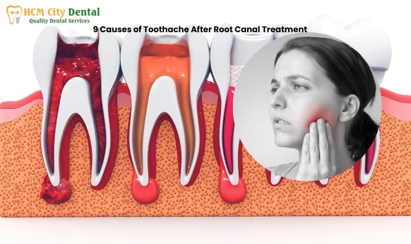 bad-breath-after-root-canal-treatment-6-dr-cuong-hcmc-dental-clinic-dr-cuong-hcmc-dental-clinic