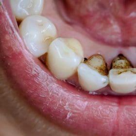 Black Stain on Teeth: How to Get Rid Of [Solved] | Dr. Cuong