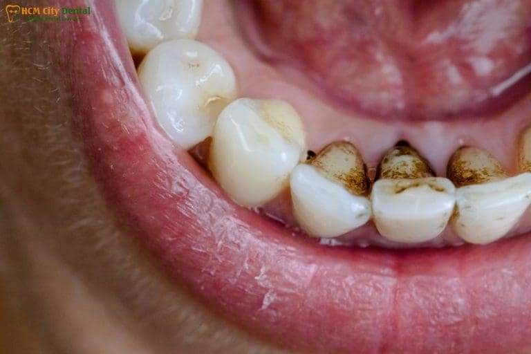 Black Stain on Teeth: How to Get Rid Of [Solved] | Dr. Cuong