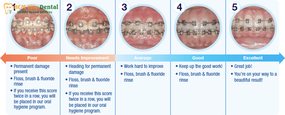 Braces Maintenance: [Pro Tips] For a Lifetime Smile | Dr. Cuong - Ho ...
