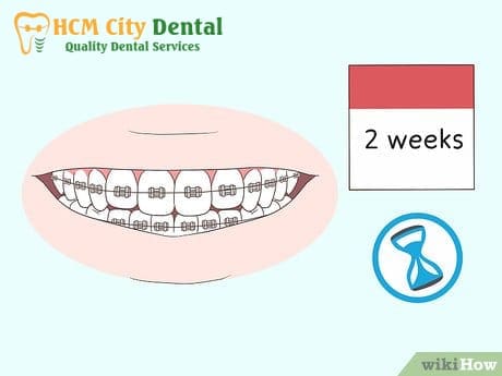 can-people-with-braces-kiss-4-dr-cuong-hcmc-dental-clinic-dr-cuong-hcmc-dental-clinic