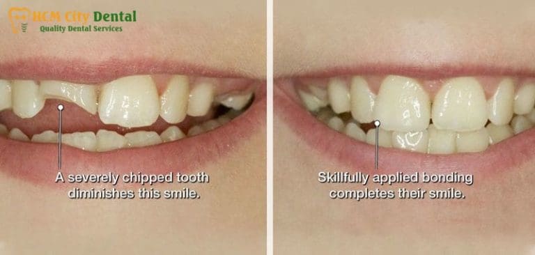 Direct Composite Veneers & Same-Day Cosmetic Bonding in Vietnam (1-Visit Smile Fix) at HCMC Dental Clinic
