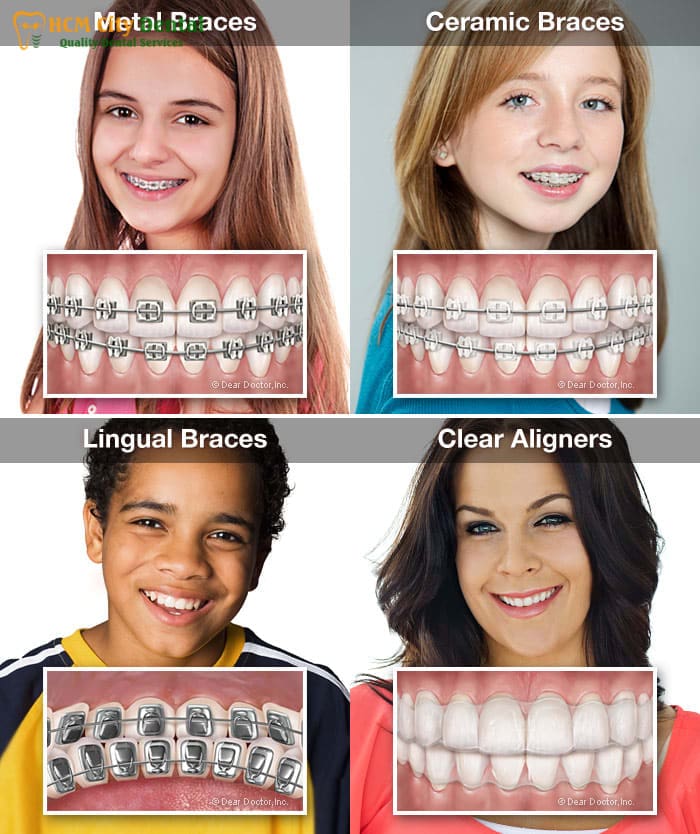 cost-of-orthodontics-6-dr-cuong-hcmc-dental-clinic-dr-cuong-hcmc-dental-clinic
