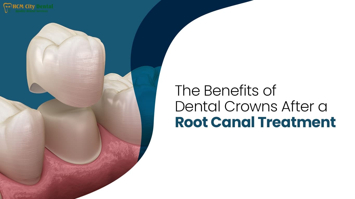 Crown After Root Canal: What You Must Know | Dr. Cuong Ho Chi Minh City ...