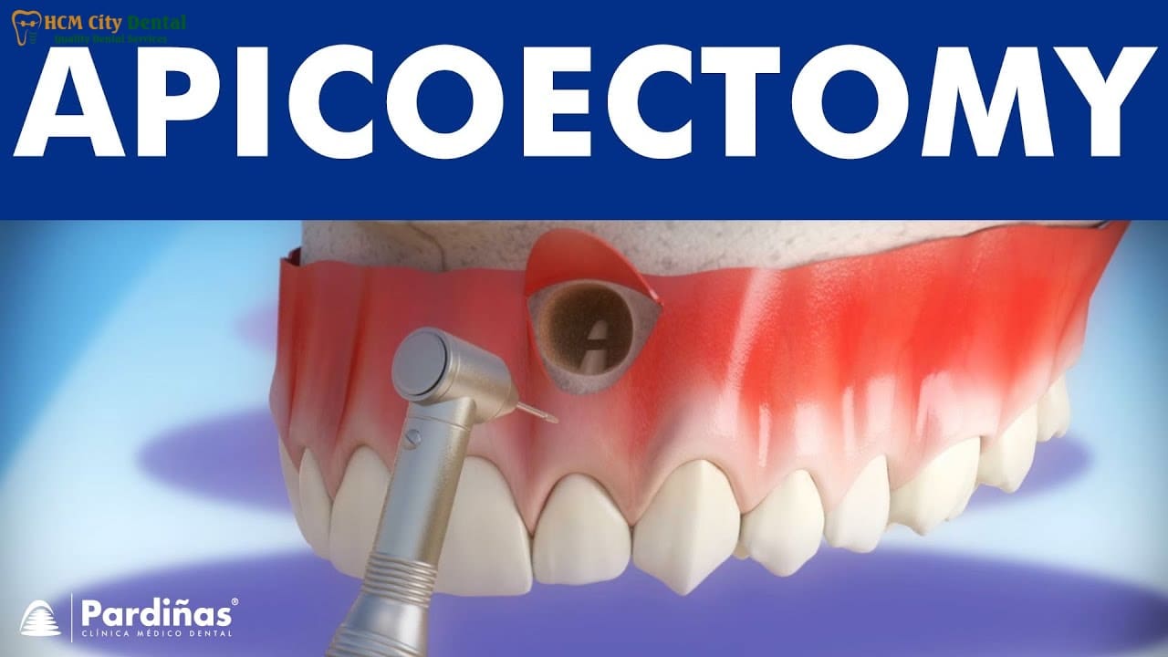 Dental Procedure Apicoectomy: Is It For You? | Dr. Cuong Ho Chi Minh ...