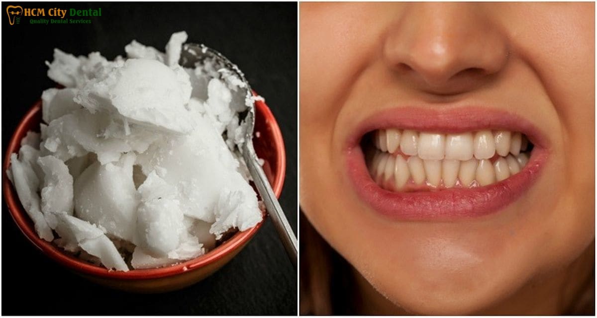 does-coconut-oil-make-teeth-whiter-3-dr-cuong-hcmc-dental-clinic-dr-cuong-hcmc-dental-clinic