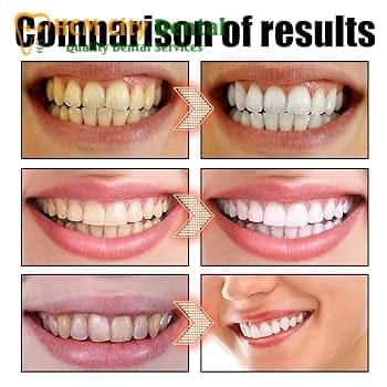 does-coconut-oil-make-teeth-whiter-5-dr-cuong-hcmc-dental-clinic-dr-cuong-hcmc-dental-clinic