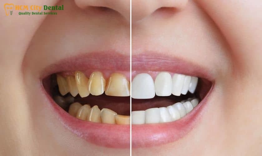 does-coconut-oil-make-teeth-whiter-6-dr-cuong-hcmc-dental-clinic-dr-cuong-hcmc-dental-clinic