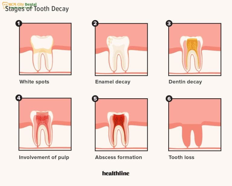 Early Signs of Tooth Decay: 7 Warning Signals to Spot Now | Dr. Cuong