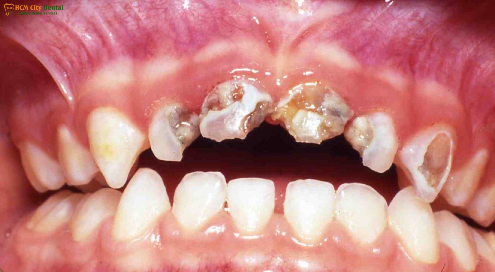 effects-of-sugar-on-teeth-2-dr-cuong-hcmc-dental-clinic-dr-cuong-hcmc-dental-clinic