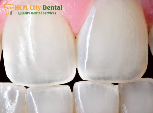 fix-tooth-enamel-3-dr-cuong-hcmc-dental-clinic-dr-cuong-hcmc-dental-clinic