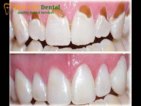 fix-tooth-enamel-4-dr-cuong-hcmc-dental-clinic-dr-cuong-hcmc-dental-clinic