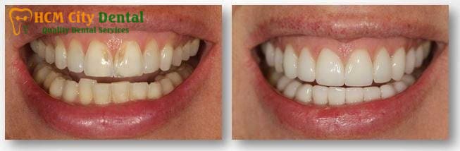 fix-tooth-enamel-6-dr-cuong-hcmc-dental-clinic-dr-cuong-hcmc-dental-clinic