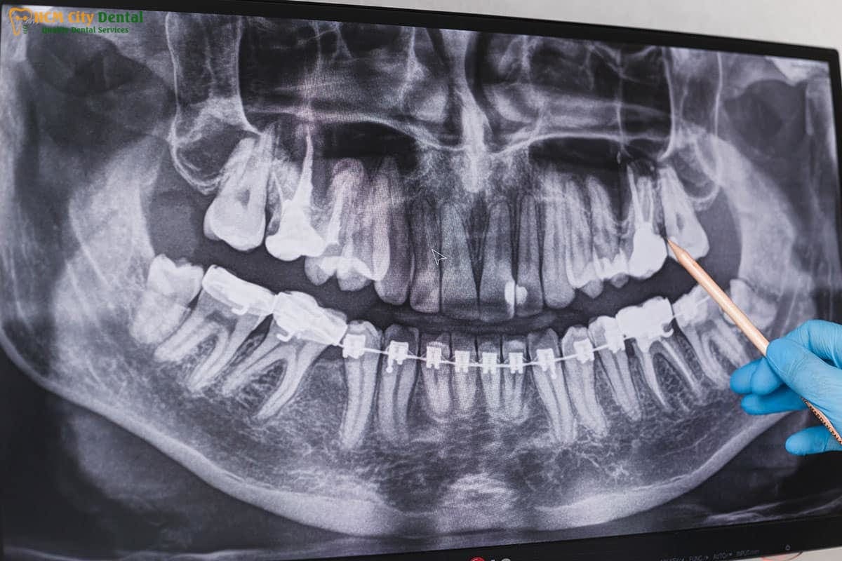 how-long-after-wisdom-teeth-removal-can-i-work-out-5-dr-cuong-hcmc-dental-clinic-dr-cuong-hcmc-dental-clinic