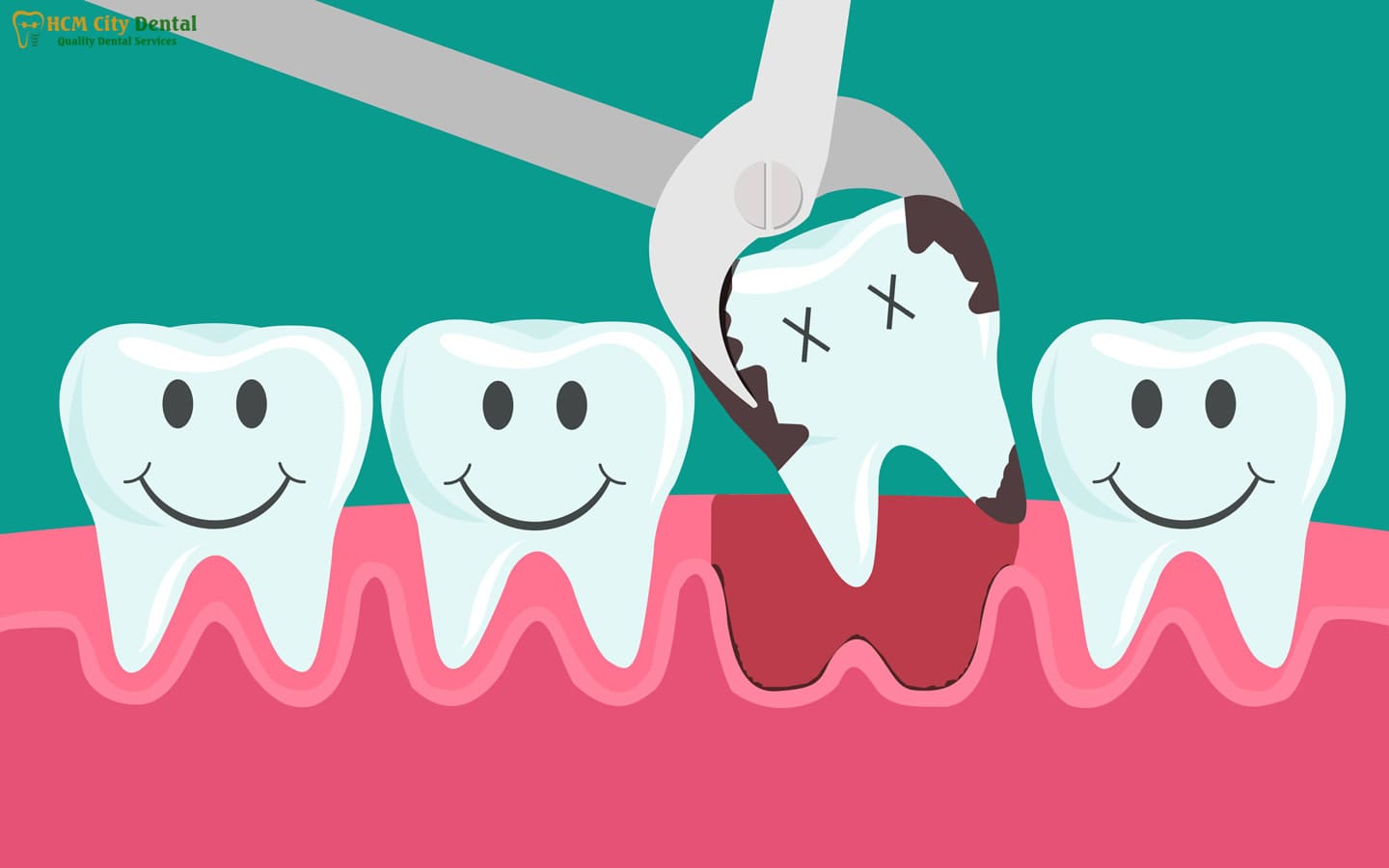 how-long-after-wisdom-teeth-removal-can-i-work-out-6-dr-cuong-hcmc-dental-clinic-dr-cuong-hcmc-dental-clinic