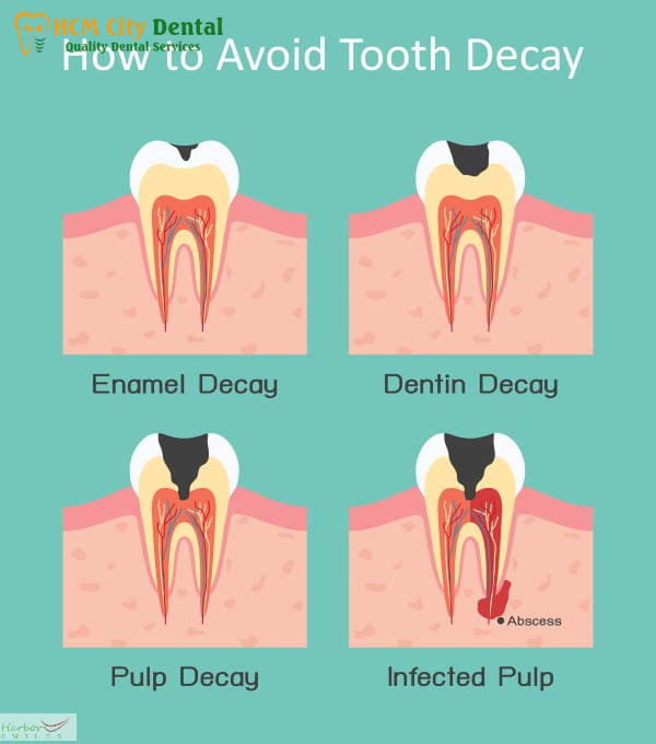 How to Avoid Tooth Decay: [5 Mistakes to Stop Now] | Dr. Cuong