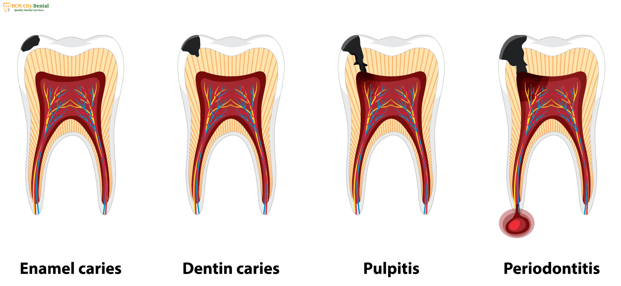 how-to-avoid-tooth-decay-4-dr-cuong-hcmc-dental-clinic-dr-cuong-hcmc-dental-clinic