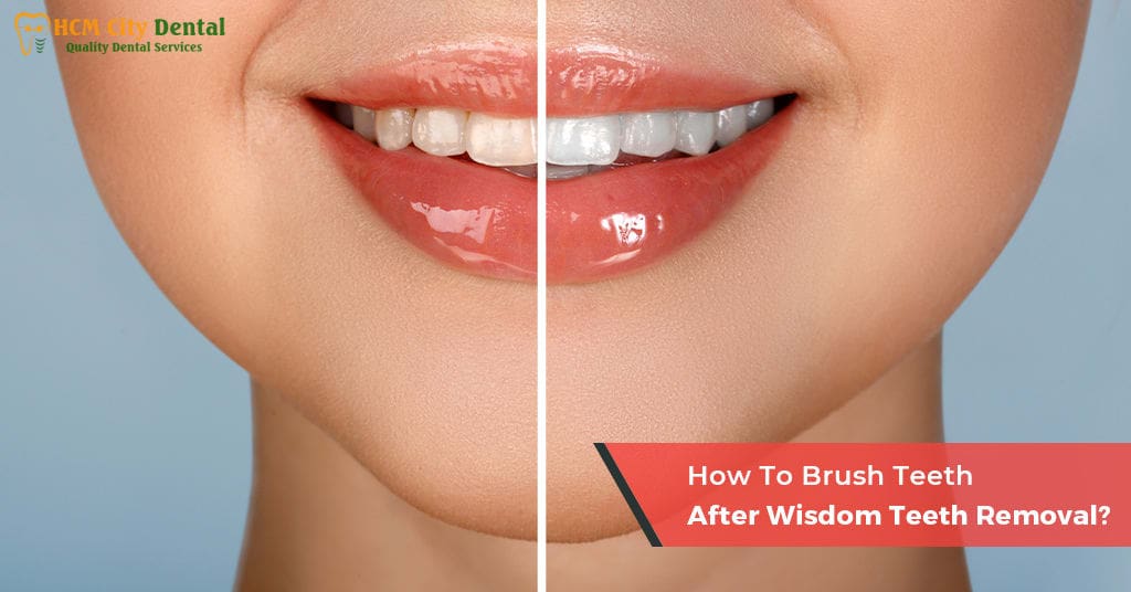 how-to-brush-your-teeth-after-wisdom-teeth-removal-3-dr-cuong-hcmc-dental-clinic-dr-cuong-hcmc-dental-clinic