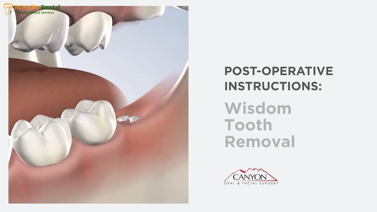 how-to-brush-your-teeth-after-wisdom-teeth-removal-4-dr-cuong-hcmc-dental-clinic-dr-cuong-hcmc-dental-clinic