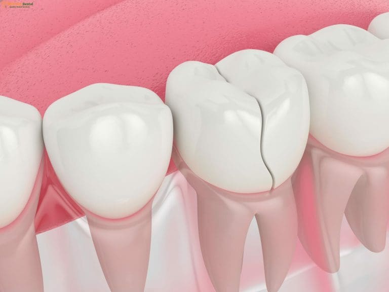 How to Fix a Fractured Tooth Fast – Expert Tips & Remedies | Dr. Cuong