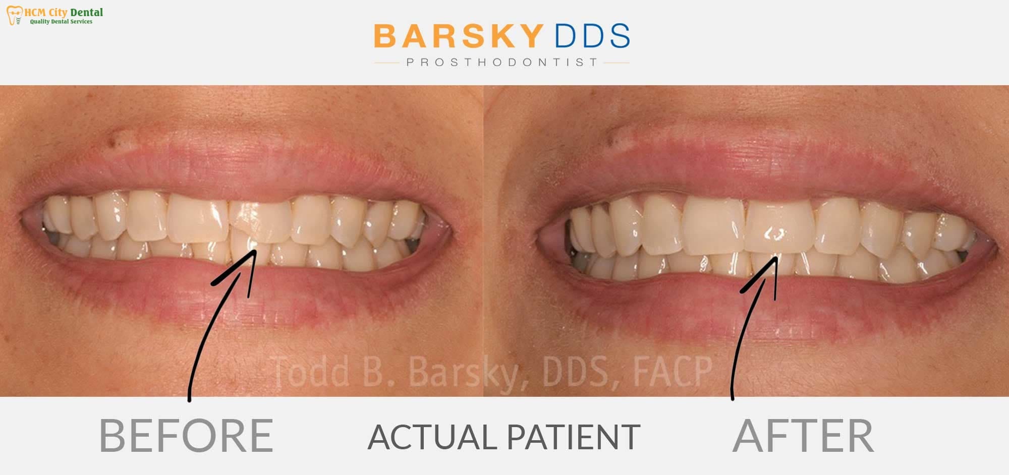 how-to-fix-a-fractured-tooth-3-dr-cuong-hcmc-dental-clinic-dr-cuong-hcmc-dental-clinic