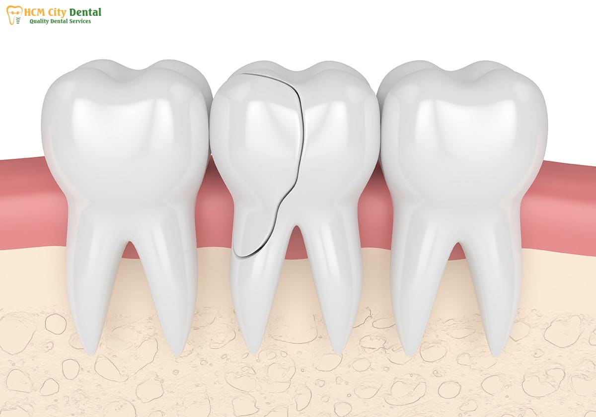 how-to-fix-a-fractured-tooth-4-dr-cuong-hcmc-dental-clinic-dr-cuong-hcmc-dental-clinic