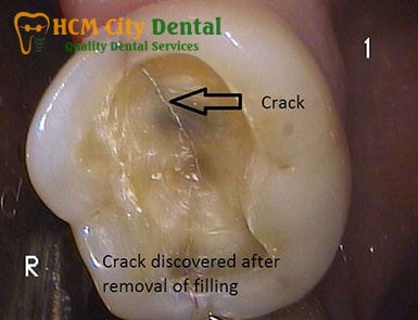 how-to-fix-a-fractured-tooth-5-dr-cuong-hcmc-dental-clinic-dr-cuong-hcmc-dental-clinic