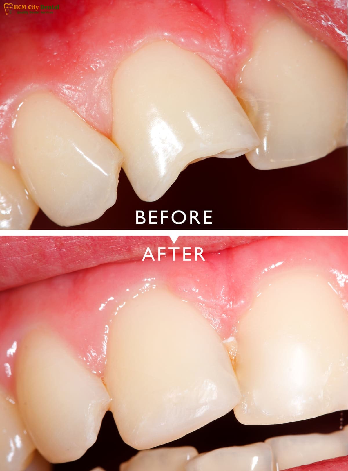 how-to-fix-a-fractured-tooth-6-dr-cuong-hcmc-dental-clinic-dr-cuong-hcmc-dental-clinic