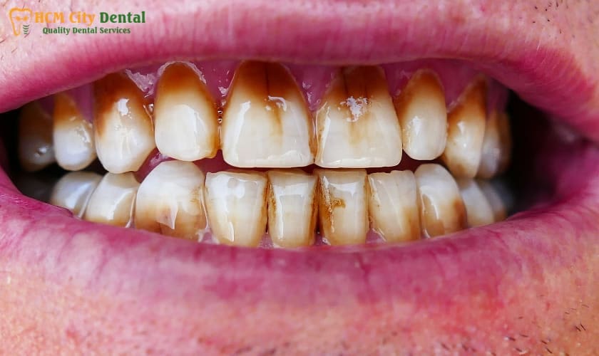 How to Remove Coffee Stains from Teeth at Home - 5 Easy Tips | Dr ...