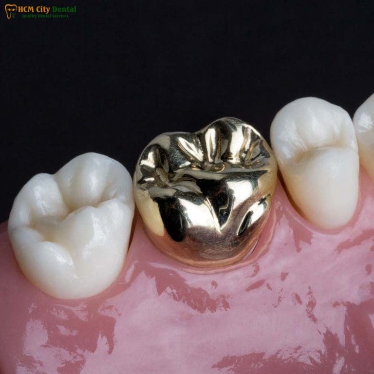 Metal Crown Tooth: Benefits You Didn’t Know | Dr. Cuong