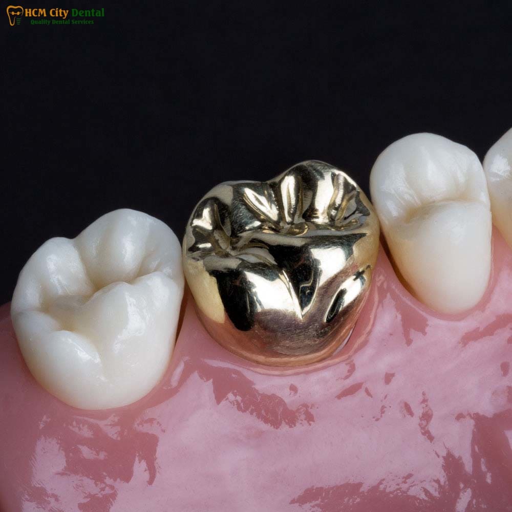 metal-crown-tooth-1-dr-cuong-hcmc-dental-clinic-dr-cuong-hcmc-dental-clinic