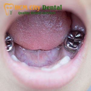 metal-crown-tooth-3-dr-cuong-hcmc-dental-clinic-dr-cuong-hcmc-dental-clinic