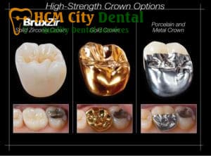 metal-crown-tooth-4-dr-cuong-hcmc-dental-clinic-dr-cuong-hcmc-dental-clinic