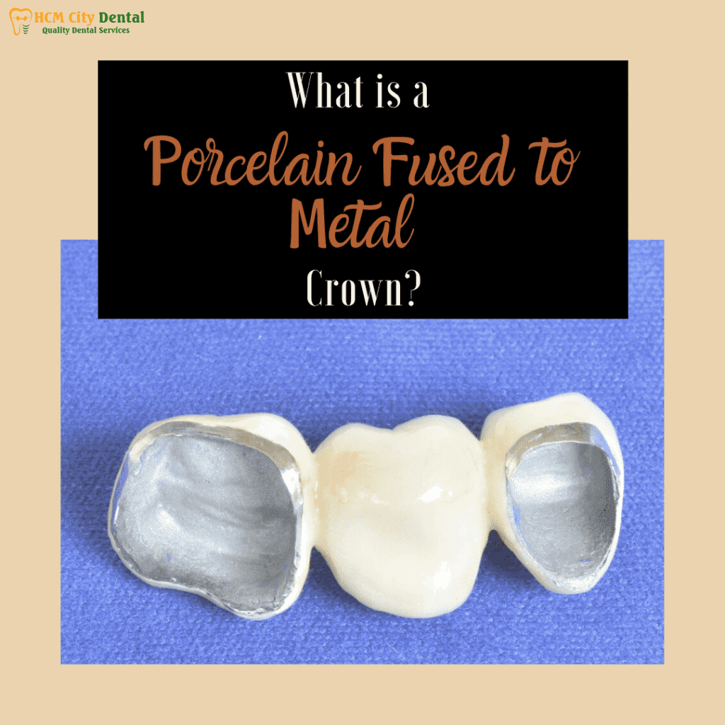 metal-crown-tooth-5-dr-cuong-hcmc-dental-clinic-dr-cuong-hcmc-dental-clinic