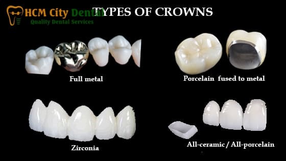 metal-crown-tooth-6-dr-cuong-hcmc-dental-clinic-dr-cuong-hcmc-dental-clinic