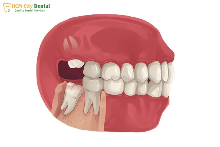 No Wisdom Teeth: [Your Health & What It Means] | Dr. Cuong