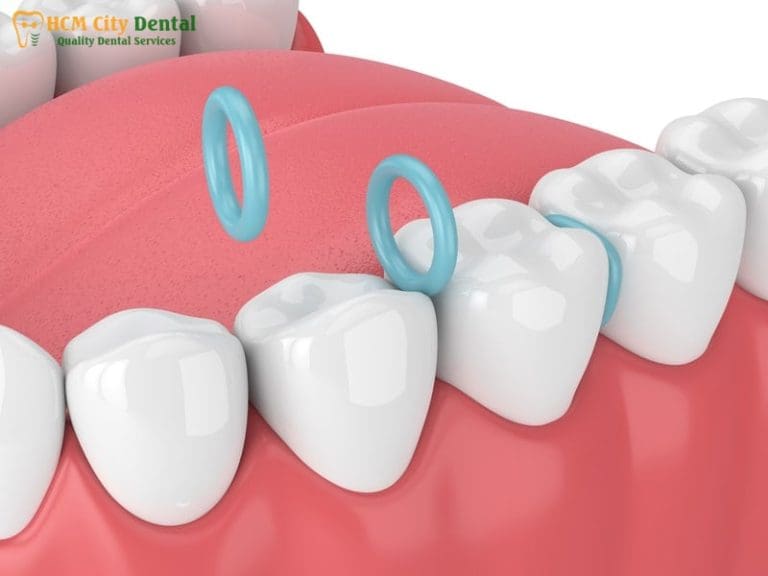 Orthodontic Spacers Pain: 7 Ways to Get Relief Fast | Dr. Cuong