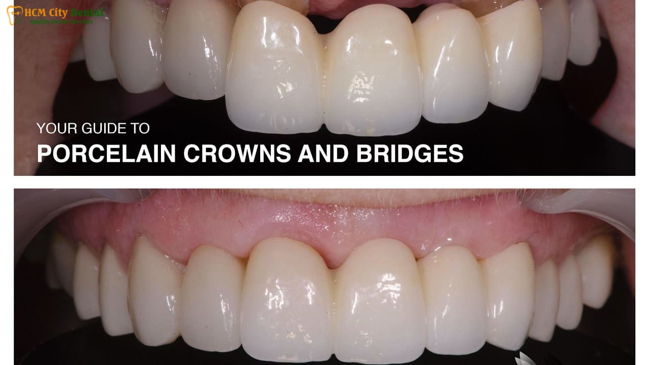Porcelain Dental Bridge: [Your Guide] to a Perfect Smile | Dr. Cuong