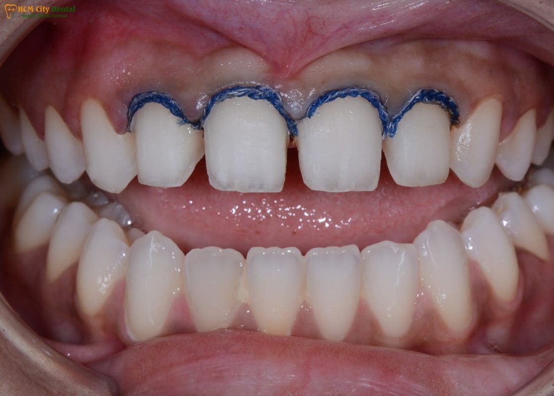 Porcelain Veneers vs. Dental Crowns in Vietnam: Conservative Enamel-Preserving Clinical Matrix at HCMC Dental Clinic