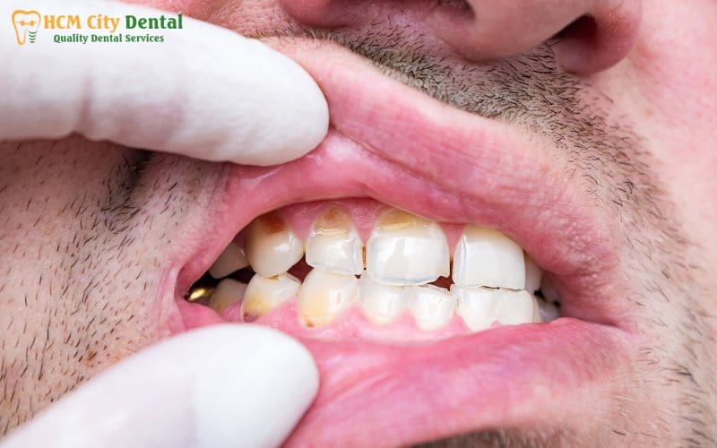 protect-tooth-enamel-5-dr-cuong-hcmc-dental-clinic-dr-cuong-hcmc-dental-clinic