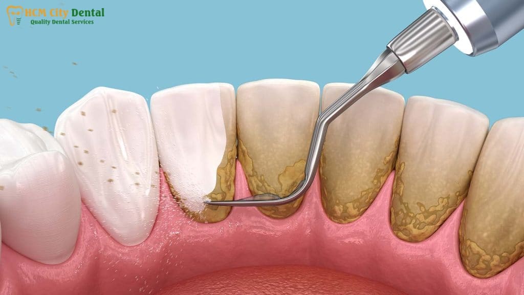 remove-plaque-from-teeth-2-dr-cuong-hcmc-dental-clinic-dr-cuong-hcmc-dental-clinic