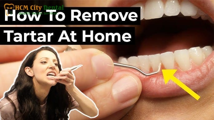 remove-plaque-from-teeth-4-dr-cuong-hcmc-dental-clinic-dr-cuong-hcmc-dental-clinic