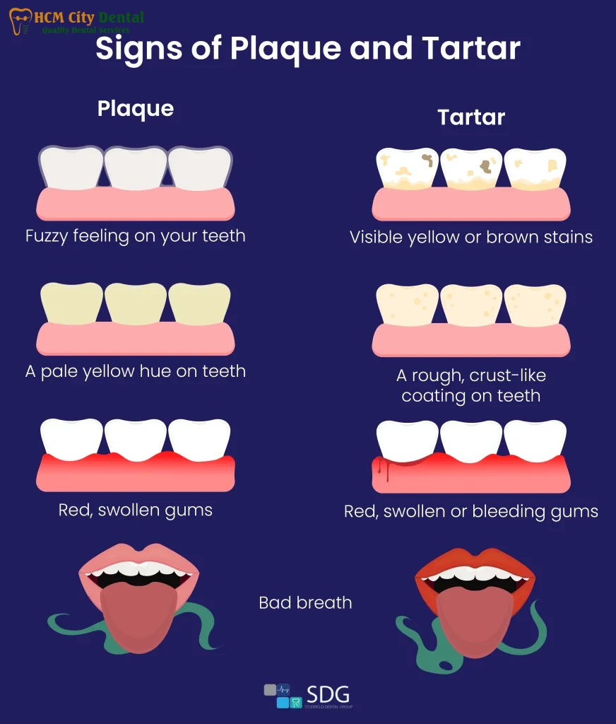 remove-plaque-from-teeth-5-dr-cuong-hcmc-dental-clinic-dr-cuong-hcmc-dental-clinic