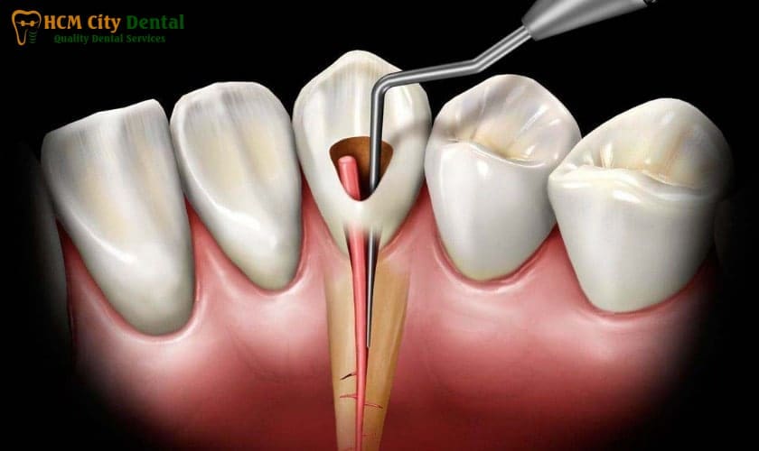root-canal-pain-2-dr-cuong-hcmc-dental-clinic-dr-cuong-hcmc-dental-clinic