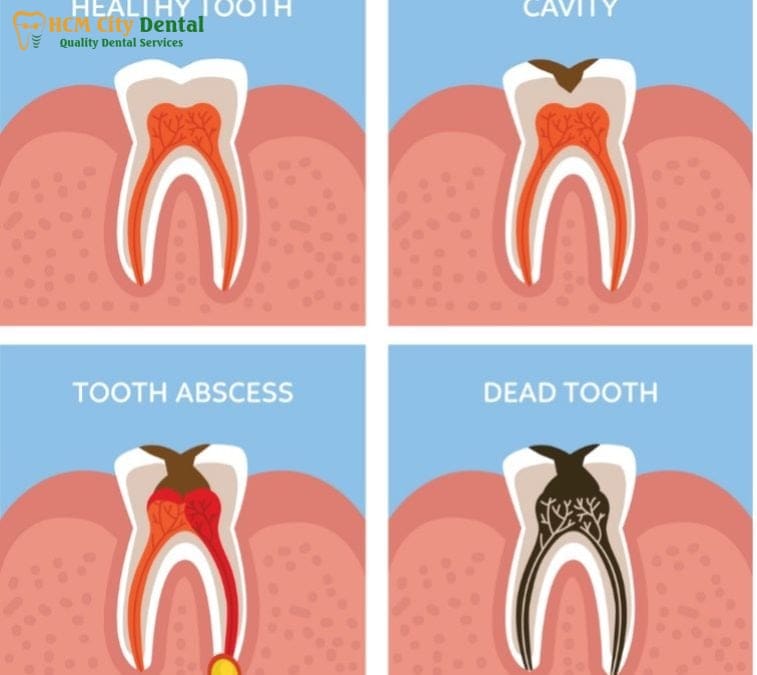 root-canal-pain-3-dr-cuong-hcmc-dental-clinic-dr-cuong-hcmc-dental-clinic