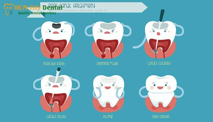root-canal-pain-4-dr-cuong-hcmc-dental-clinic-dr-cuong-hcmc-dental-clinic