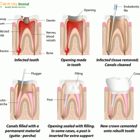 Surgical Apicoectomy & Microscopic Endodontic Retreatment in Vietnam (MTA Bioceramic Root-End Seal) at HCMC Dental Clinic